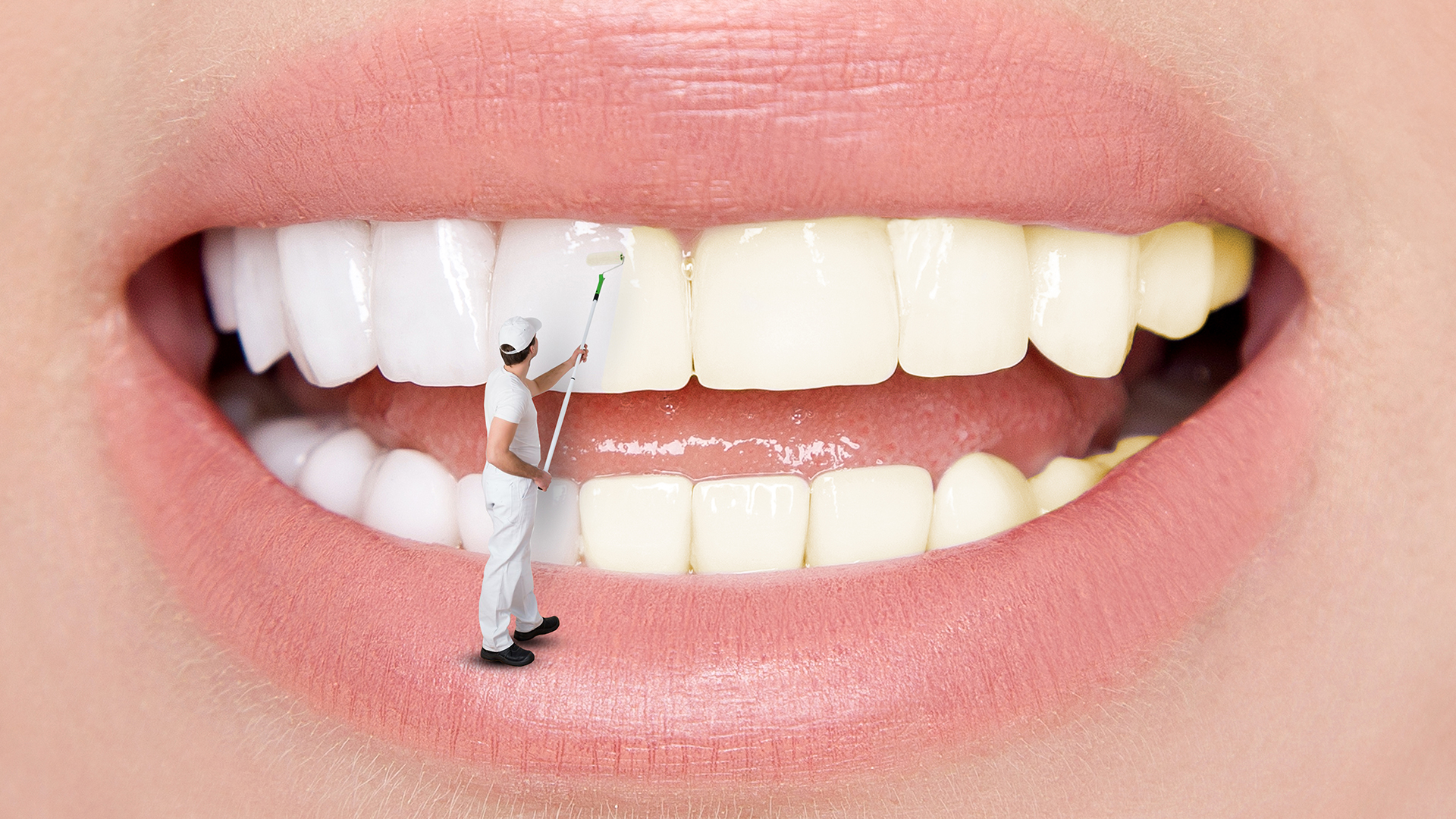 Teeth Whitening Process - Plastic surgery in Istanbul