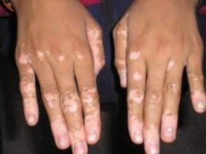 Addison's Disease - Plastic surgery in Istanbul