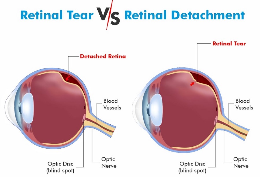 What is Retinal Detachment and Retinal Tear? Plastic surgery in Istanbul
