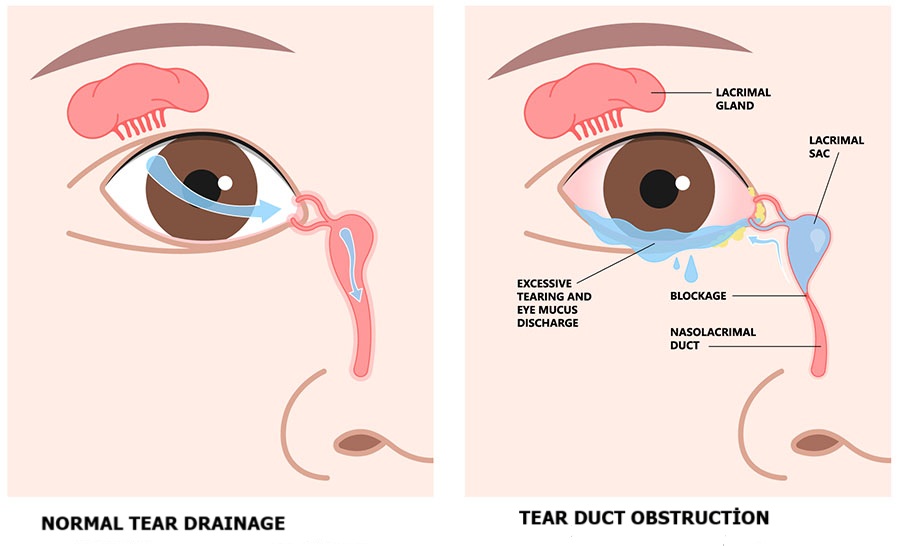 Obstructive Defacation What is Tear Duct Obstruction? - Plastic surgery in Istanbul